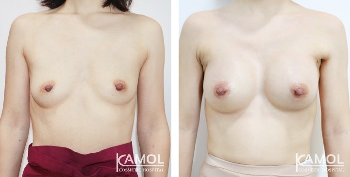 Breast Augmentation 5 lg 6494959d10de7 image