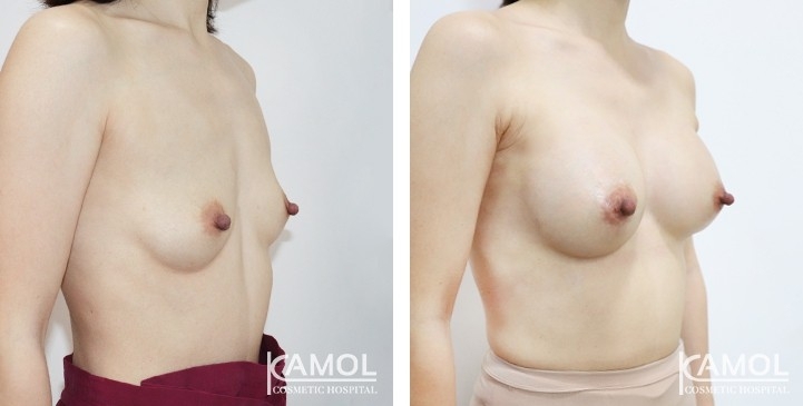 Breast Augmentation 6 lg 6494959d12e9a image