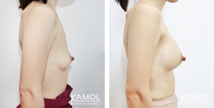 Breast Augmentation 7 lg 6494959d14dd5 image
