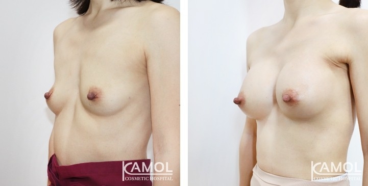 Breast Augmentation 8 lg 6494959d16aba image