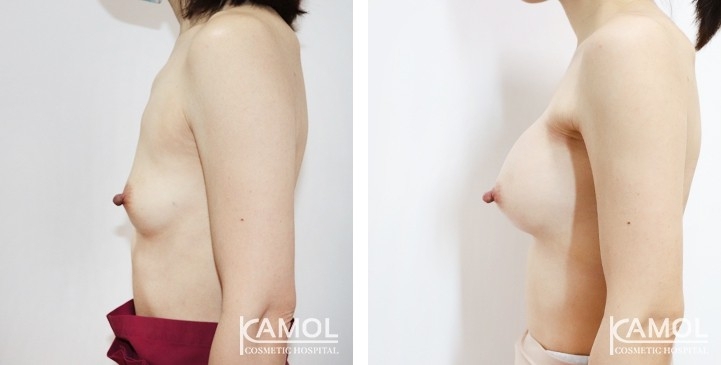 Breast Augmentation 9 lg 6494959d187a7 image