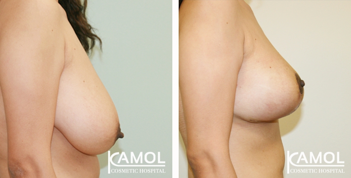 Breast Reduction 4 lg 6494959e4f2af image