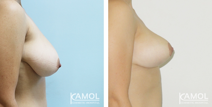 Breast Reduction 16 lg 6494959e5b37a image