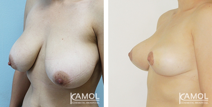 Breast Reduction 15 lg 6494959e5e8c4 image