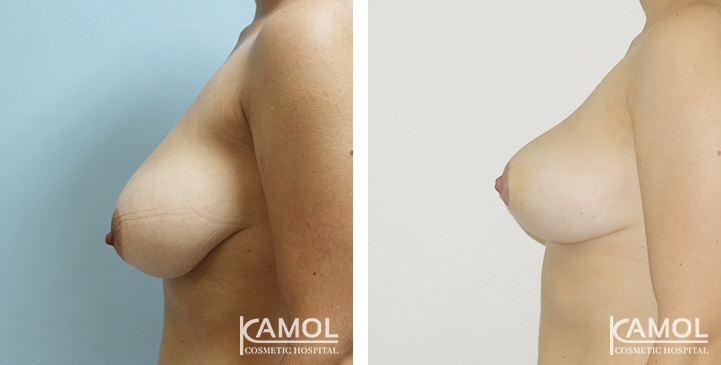 Breast Reduction 14 lg 6494959e607a5 image