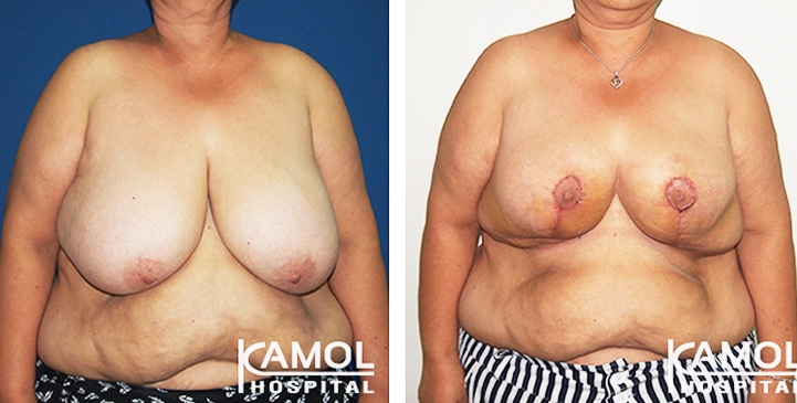 Breast Reduction 21 lg 6494959e6c4b1 image