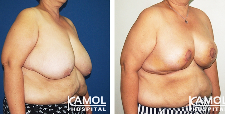 Breast Reduction 23 lg 6494959e6e866 image