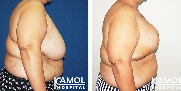 Breast Reduction 22 lg 6494959e7262e image