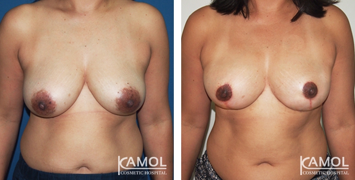 Breast Reduction 25 lg 6494959e767b9 image