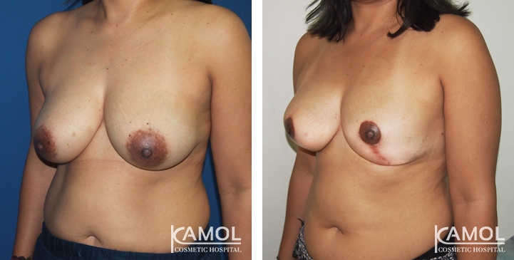Breast Reduction 27 lg 6494959e78c2f image