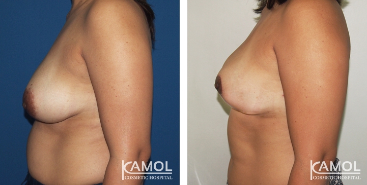 Breast Reduction 29 lg 6494959e7bab3 image
