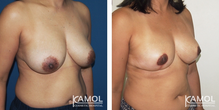 Breast Reduction 28 lg 6494959e7e395 image