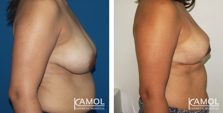 Breast Reduction 26 lg 6494959e814e1 image