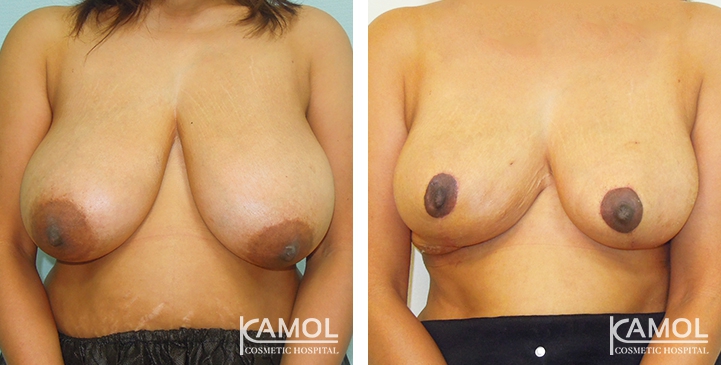 Breast Reduction 31 lg 6494959e84944 image