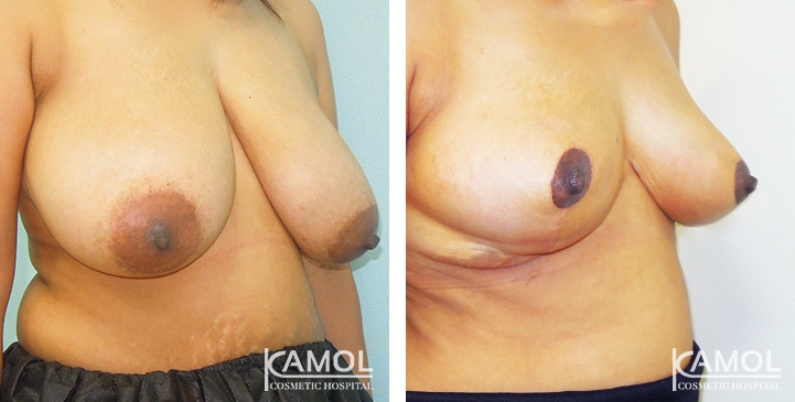 Breast Reduction 32 lg 6494959e8836f image