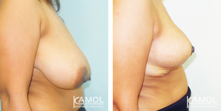 Breast Reduction 35 lg 6494959e8a1f1 image