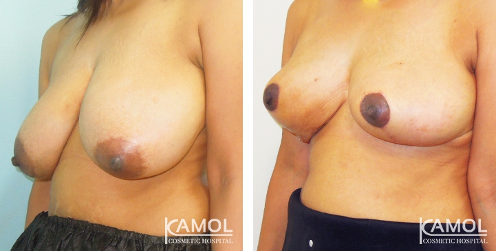 Breast Reduction 34 lg 6494959e8d6fa image