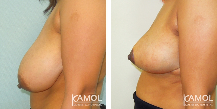 Breast Reduction 33 lg 6494959e8f9dc image