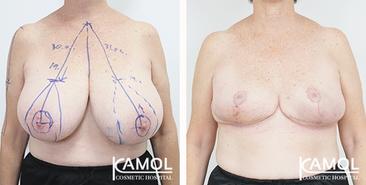 Breast Reduction 37 lg 6494959e93802 image