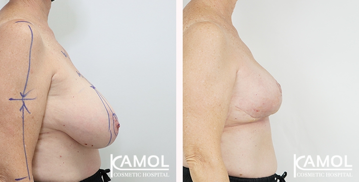Breast Reduction 40 lg 6494959e97bb5 image