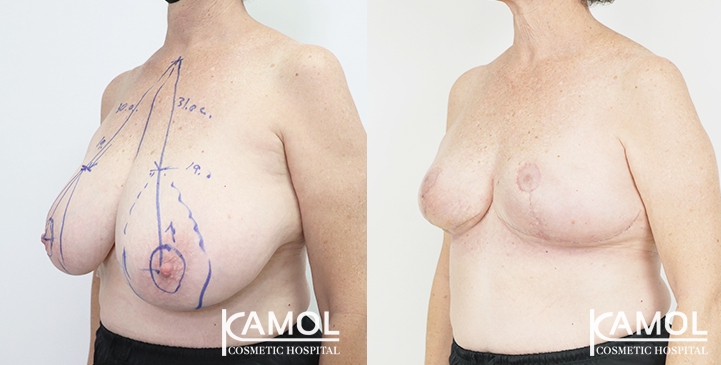 Breast Reduction 38 lg 6494959e99524 image