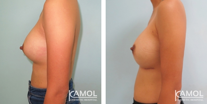 Revisão de Implantes Mamários 13 lg 6494959eb6187 image
