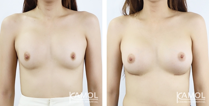 Revisão de Implantes Mamários 29 lg 6494959ed53d7 image