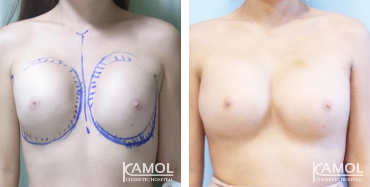 Revisão de Implantes Mamários 35 lg 6494959ee3c4e image
