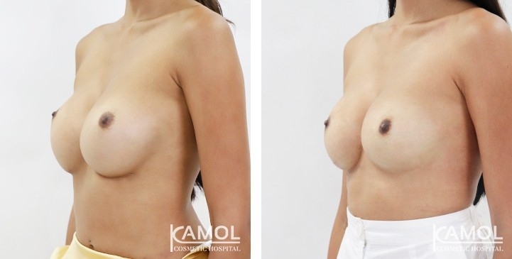 Revisão de Implantes Mamários 39 lg 6494959eecab1 image