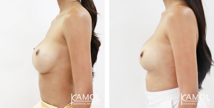 Revisão de Implantes Mamários 38 lg 6494959eeed58 image
