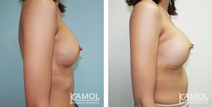 Revisão de Implantes Mamários 46 lg 6494959f03667 image