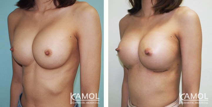 Revisão de Implantes Mamários 45 lg 6494959f059b5 image
