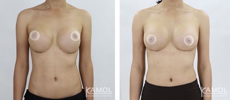 Revisão de Implantes Mamários 49 lg 6494959f0af02 image