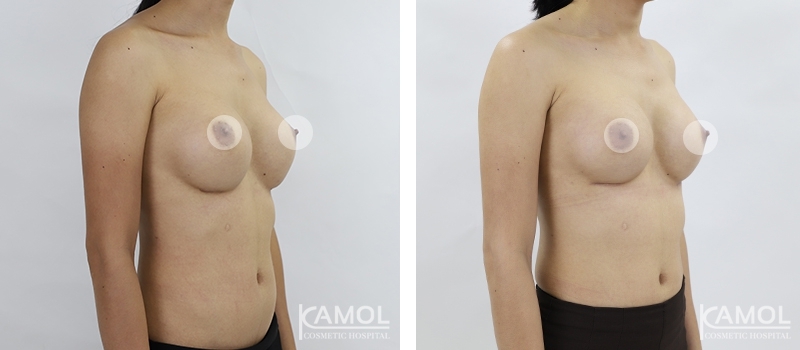 Revisão de Implantes Mamários 53 lg 6494959f0d120 image