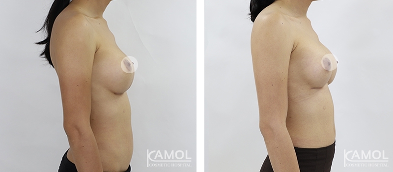Revisão de Implantes Mamários 52 lg 6494959f0f2e3 image