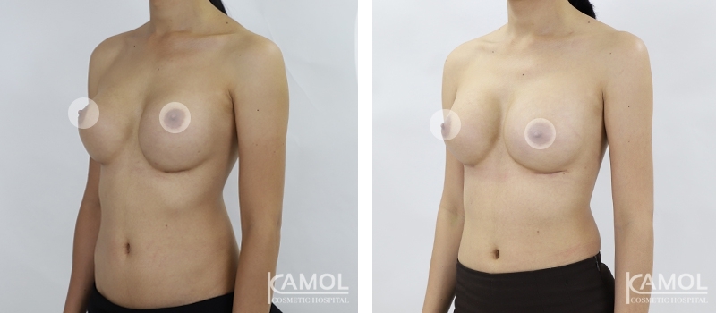 Revisão de Implantes Mamários 51 lg 6494959f11463 image