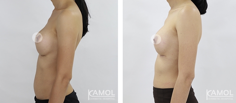 Revisão de Implantes Mamários 50 lg 6494959f13630 image