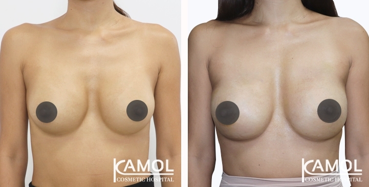 Revisão de Implantes Mamários 55 lg 6494959f16321 image