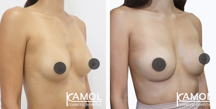 Revisão de Implantes Mamários 56 lg 6494959f182c6 image