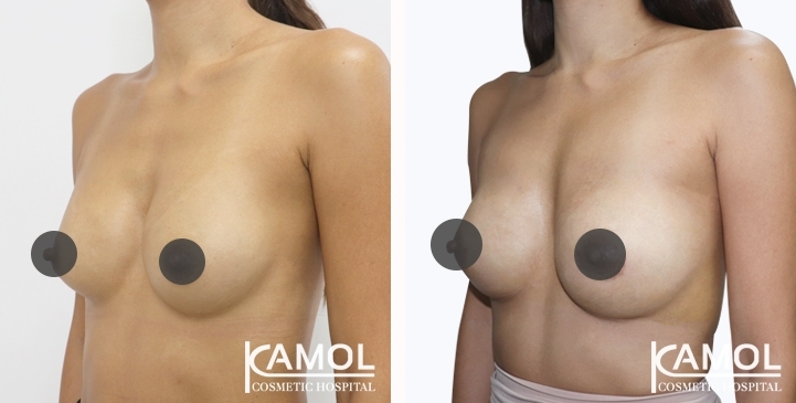 Revisão de Implantes Mamários 58 lg 6494959f1a244 image