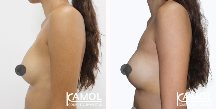 Revisão de Implantes Mamários 57 lg 6494959f1bfe1 image