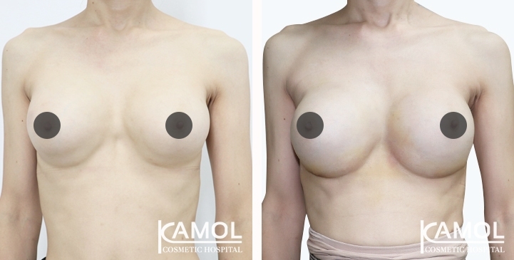 Revisão de Implantes Mamários 60 lg 6494959f20a01 image