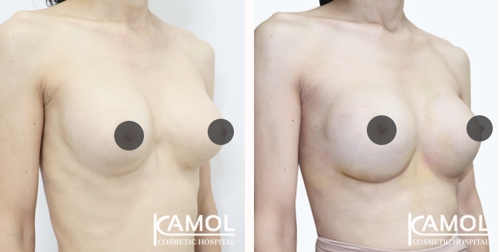 Revisão de Implantes Mamários 61 lg 6494959f22b59 image