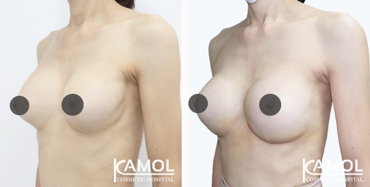 Revisão de Implantes Mamários 62 lg 6494959f268cd image
