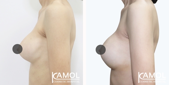 Revisão de Implantes Mamários 64 lg 6494959f287f3 image