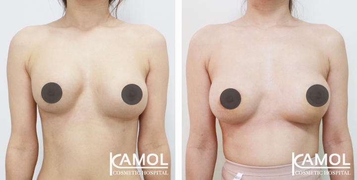Revisão de Implantes Mamários 66 lg 6494959f2b4b6 image