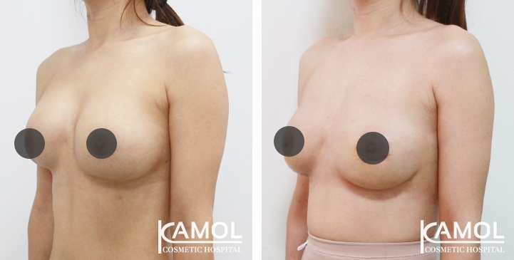 Revisão de Implantes Mamários 69 lg 6494959f2d44e image