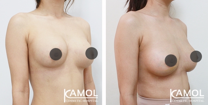 Revisão de Implantes Mamários 68 lg 6494959f2f516 image