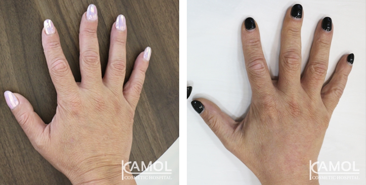 Hand Rejuvenation Treatment 2 lg 6494959f5244a image