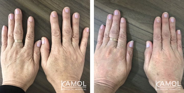 Hand Rejuvenation Treatment 4 lg 6494959f554b9 image